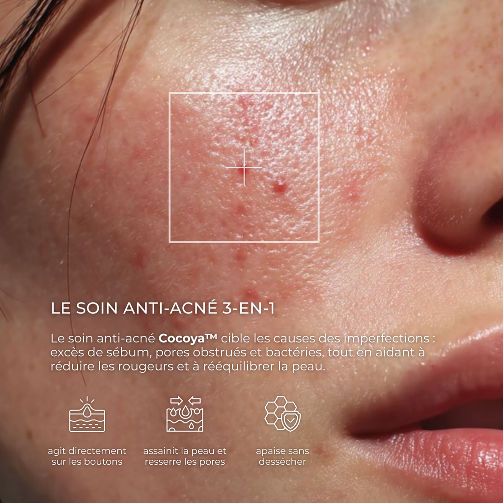 Soin anti-acné
