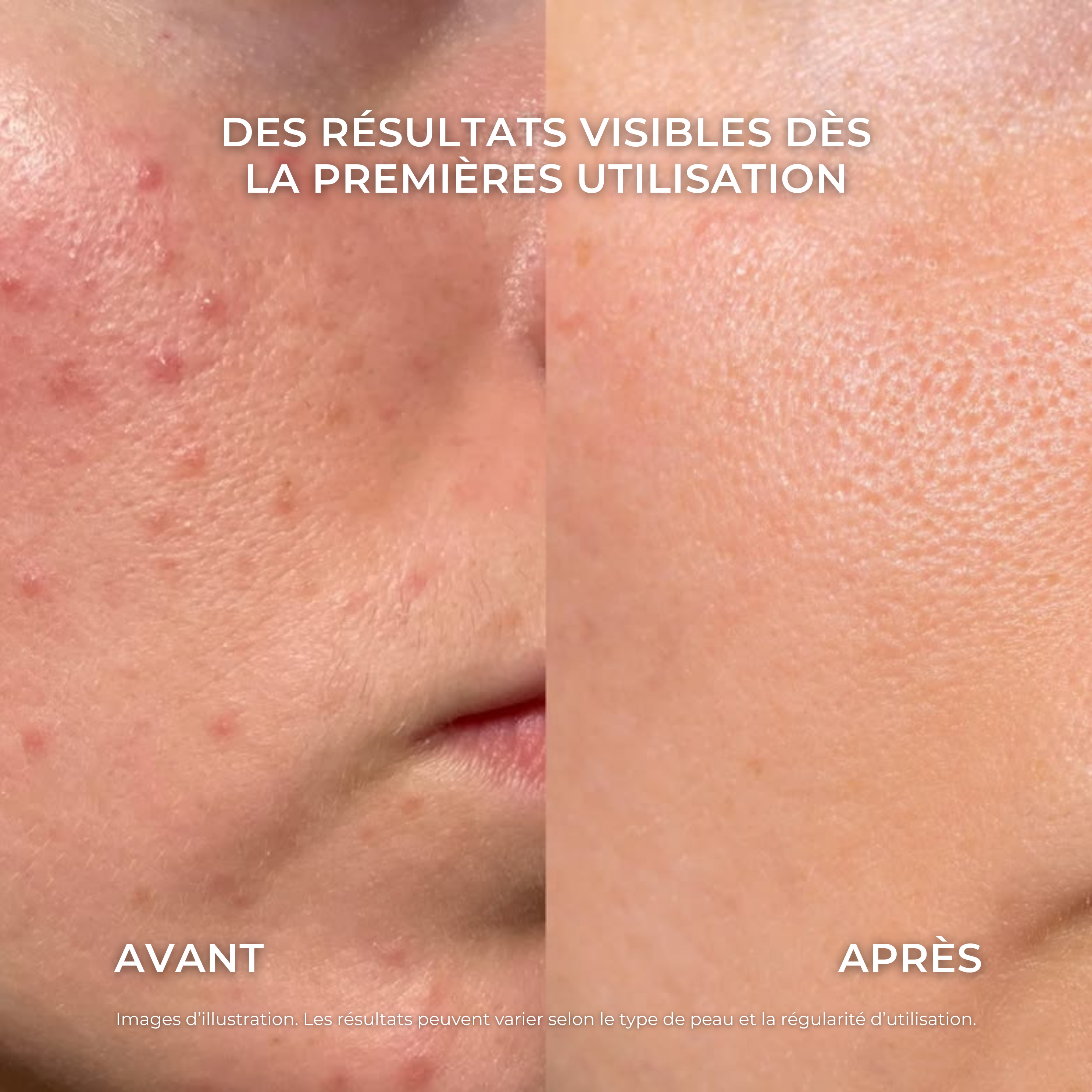 Soin anti-acné